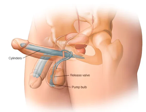 Compare Permanent and Temporary Penis Enlargement Solutions with Medgol