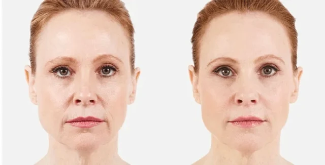 Understanding the different types of dermal fillers