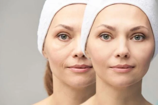 The Cost of Non-Surgical Facelifts in Turkey