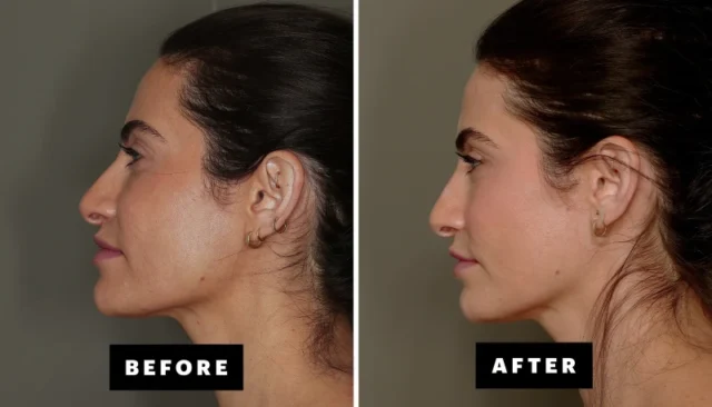 The benefits of facial fat grafting