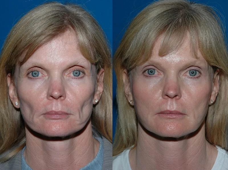 Achieve a Natural and Youthful Look with Facial Fat Grafting in Antalya