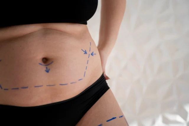 Rise in Medical Tourism for Liposuction