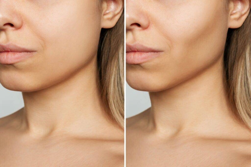 Why Buccal Fat Removal Is the Hottest Trend in Facial Contouring