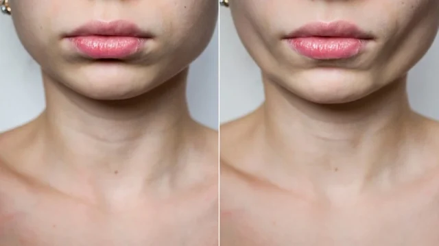 Buccal Fat Removal vs. Other Facial Contouring Procedures