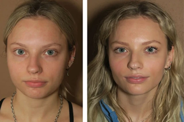 Cost of Buccal Fat Removal: What to Know