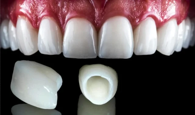 What are Zirconium Veneers?