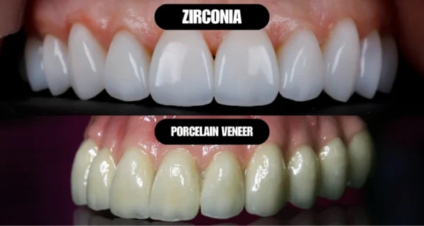Choosing Between Zirconium and Porcelain Veneers for Your Perfect Smile