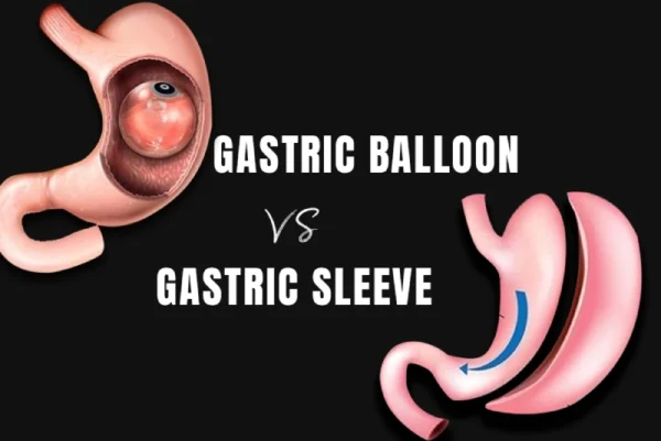 Comparing Gastric Balloon and Gastric Sleeve
