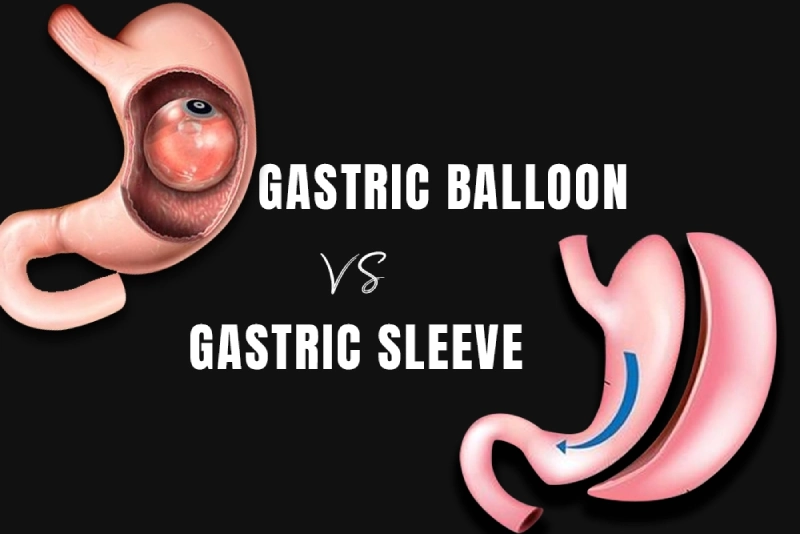 Comparing Gastric Balloon and Gastric Sleeve