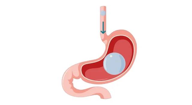 What is a Gastric Balloon?