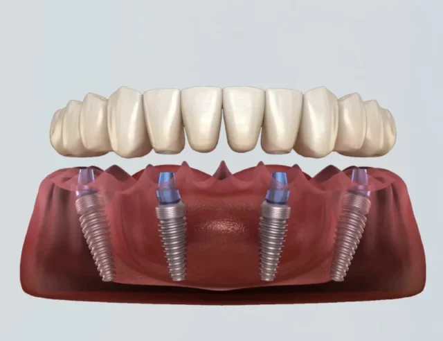 All-on-4 Dental Implants in Turkey: A Permanent Solution for Missing Teeth