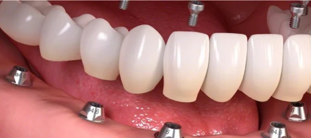 Who is a Suitable Candidate for All-on-4 Implants?