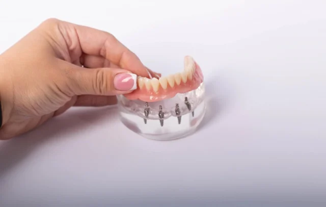 Long-term Care and Maintenance of All-on-4 Implants