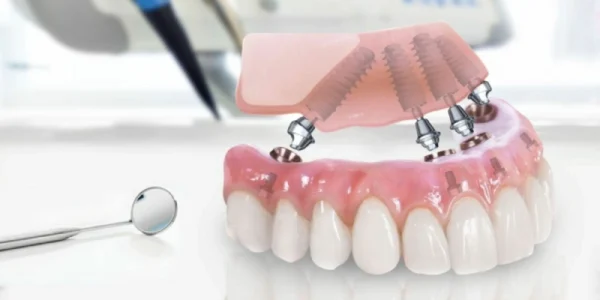 Discover the Benefits of All-on-4 Dental Implants in Turkey for a Permanent Smile