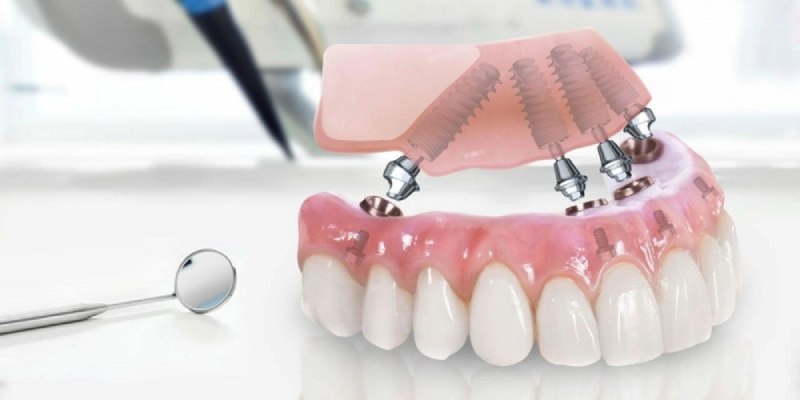 Discover the Benefits of All-on-4 Dental Implants in Turkey for a Permanent Smile