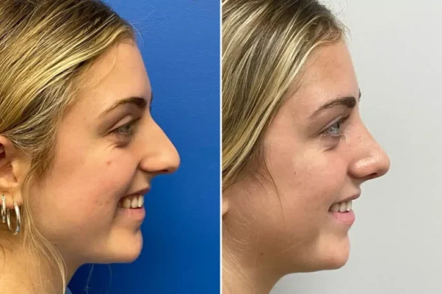 Are Non-Surgical Nose Jobs a Good Alternative to Rhinoplasty?
