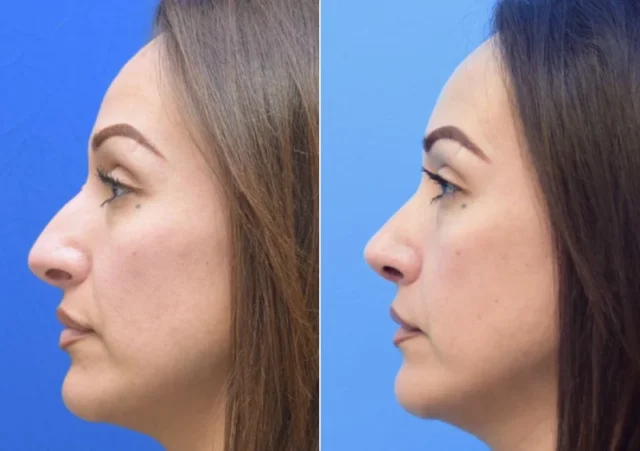 Risks and Considerations of Non-Surgical Procedures