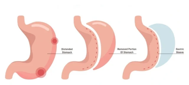 Gastric Sleeve Turkey All-Inclusive with Medgol