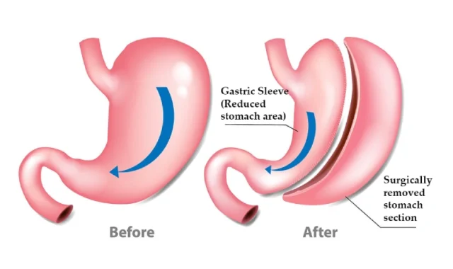 The Gastric Sleeve Procedure Explained