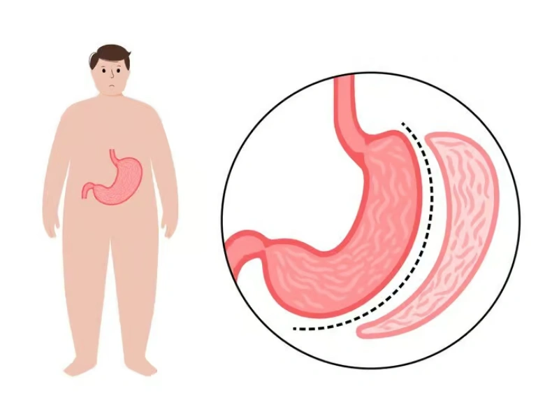 Top Countries for Gastric Sleeve Surgery