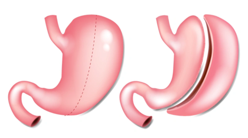 All-Inclusive Gastric Sleeve Packages in Turkey with Medgol
