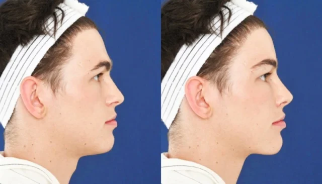 Facial Feminization Surgery: What It Is and How It Helps