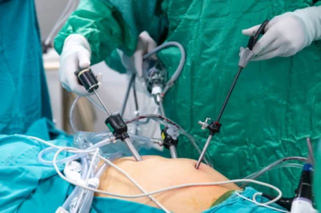 Overview of Gastric Sleeve Procedure