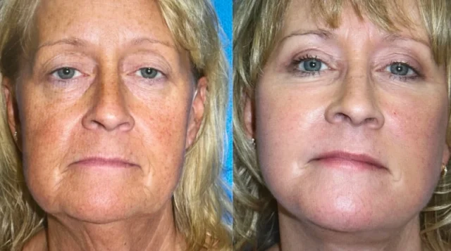 The Role of Stem Cell Therapy in Aesthetic and Regenerative Medicine in Turkey
