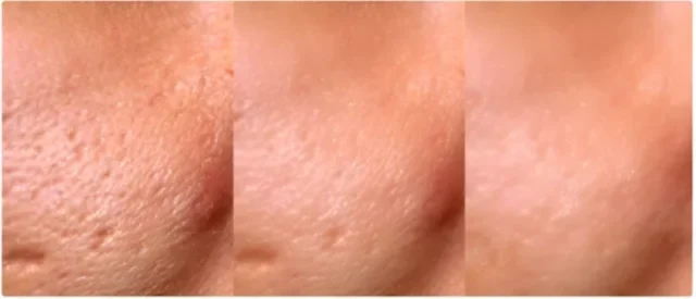 Types of Laser Treatments Available in Antalya