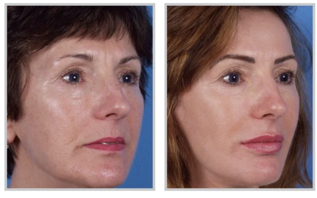 Understanding the Procedure: How Laser Skin Resurfacing Works