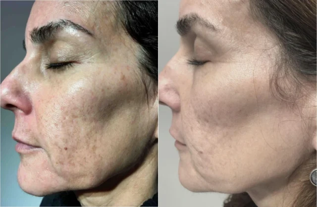 Preparing for Your Laser Skin Resurfacing Treatment