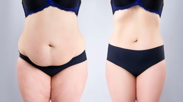 Pros and Cons of Liposuction