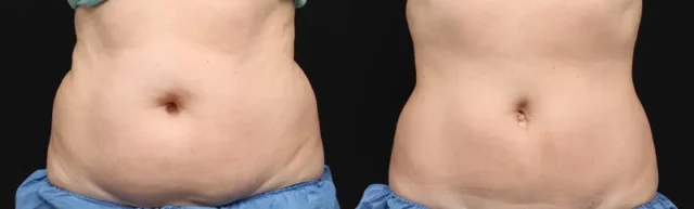 Understanding Liposuction: Procedure and Techniques