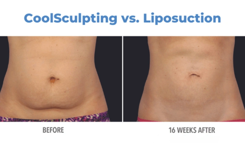 Liposuction vs. CoolSculpting