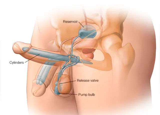Medgol’s Advanced Penis Enlargement Procedures: What’s Included?