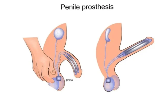 Penis Enlargement with Medgol: Safe & Effective Solutions in Istanbul