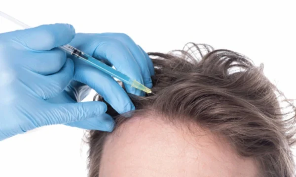 PRP vs. Mesotherapy: Choosing the Right Hair Loss Solution for You