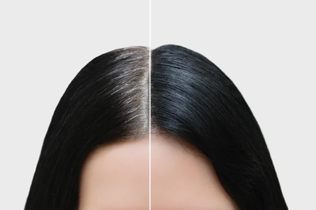 Benefits of Mesotherapy for Hair Loss