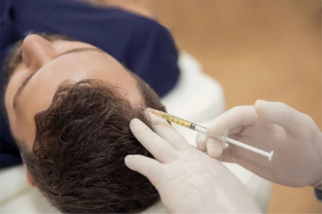 Overview of Mesotherapy for Hair Loss