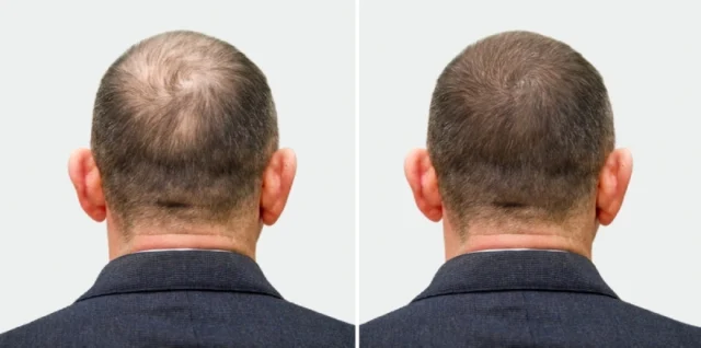 How PRP Therapy Works for Hair Regrowth