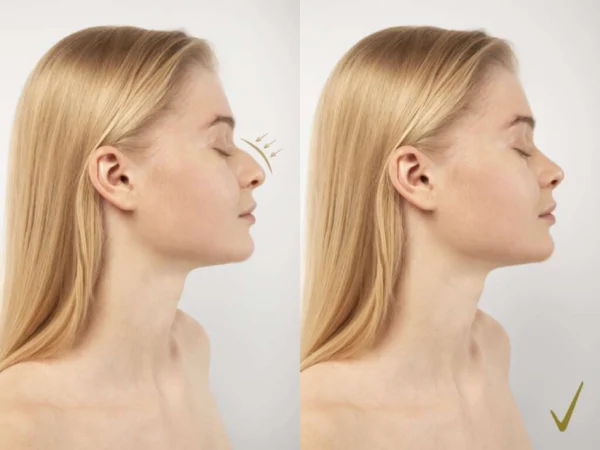 Transform Your Look with Expert Nose Surgery in Istanbul by Medgol