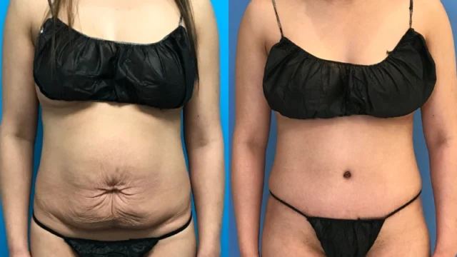Tummy Tuck vs. Liposuction: Which One Is Right for You?
Understanding Tummy Tuck and Liposuction