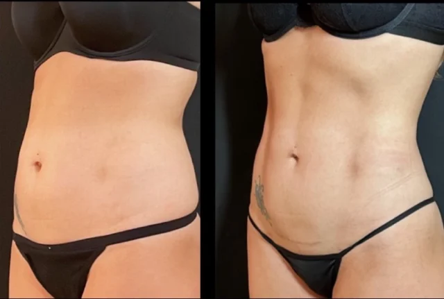 Cost Comparison: Tummy Tuck and Liposuction