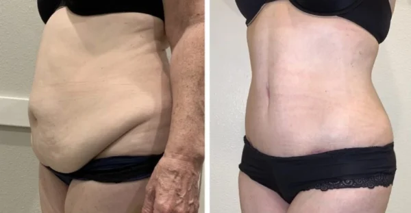 Weight Loss Surgery in Turkey