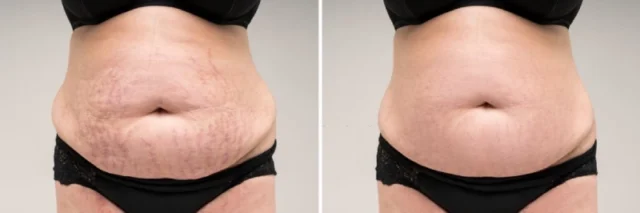 Ideal Candidates for Tummy Tuck