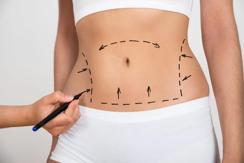 Tummy Tuck or Liposuction? How to Choose the Right Procedure for Your Body Goals