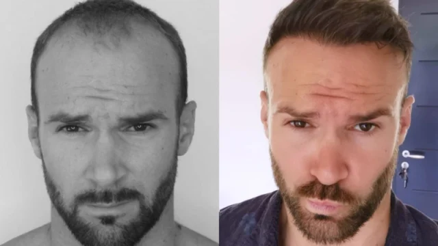 Is 3,000 Grafts Enough for a Full Hair Restoration?