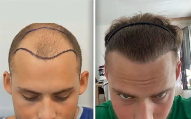 Understanding the Cost of Hair Transplants in Turkey