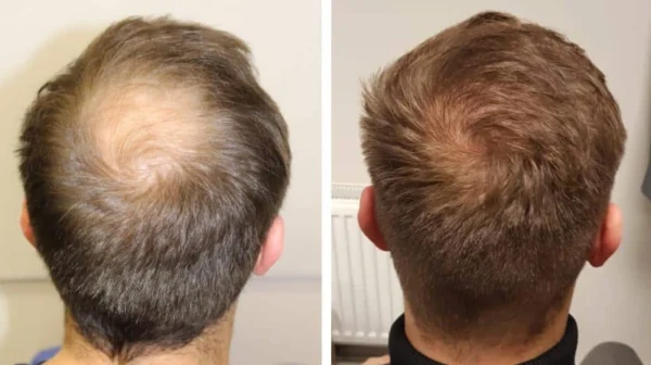 Hair Grafts in Turkey