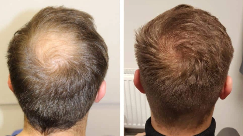 Hair Grafts in Turkey